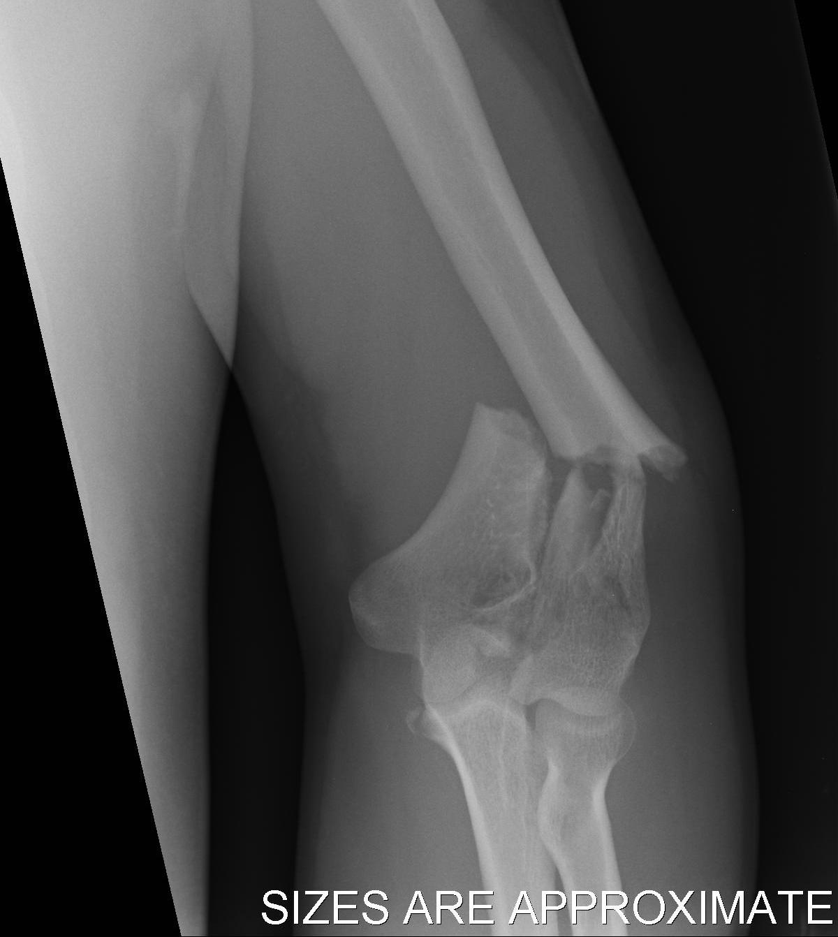 Distal Humeral Fracture AP
